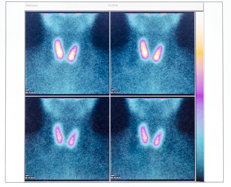 Scintigraphie et échographie thyroïdienne
